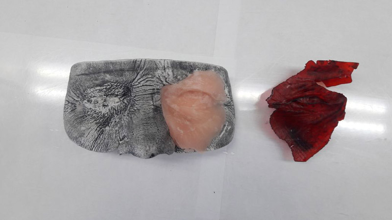 Этап печати протеза на 3D принтере Этап печати протеза на 3D принтере